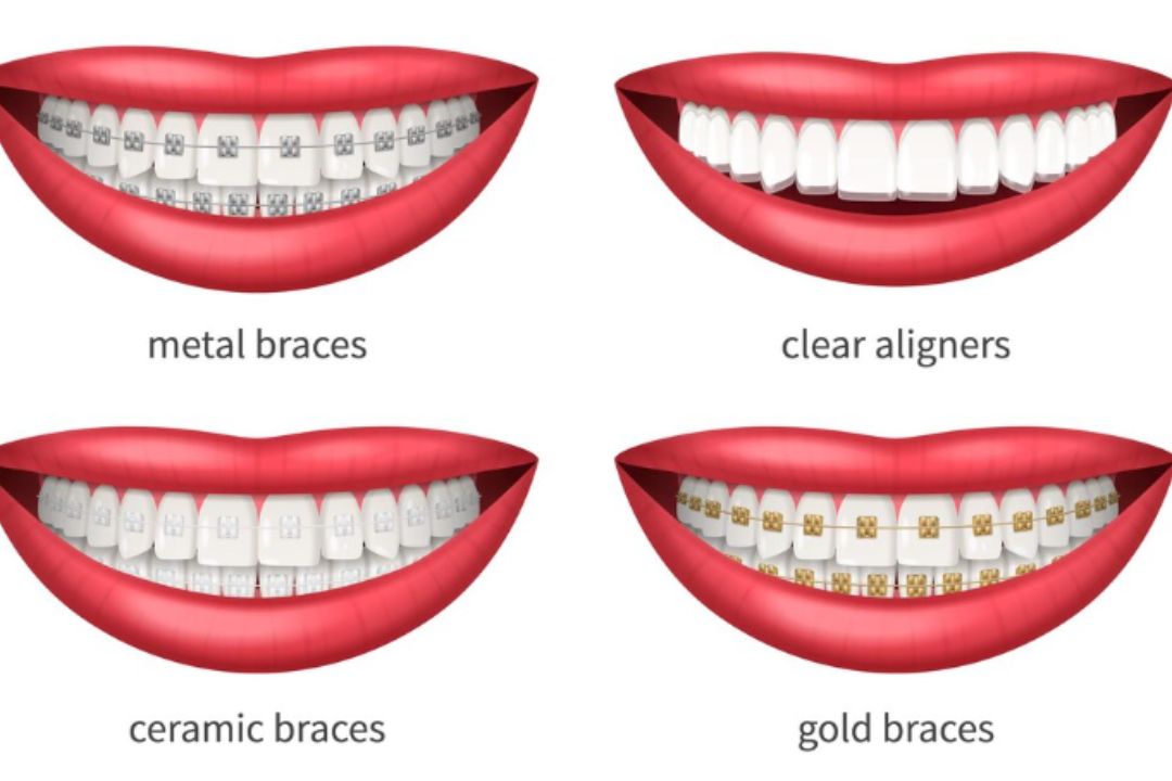 best braces types for straight teeth